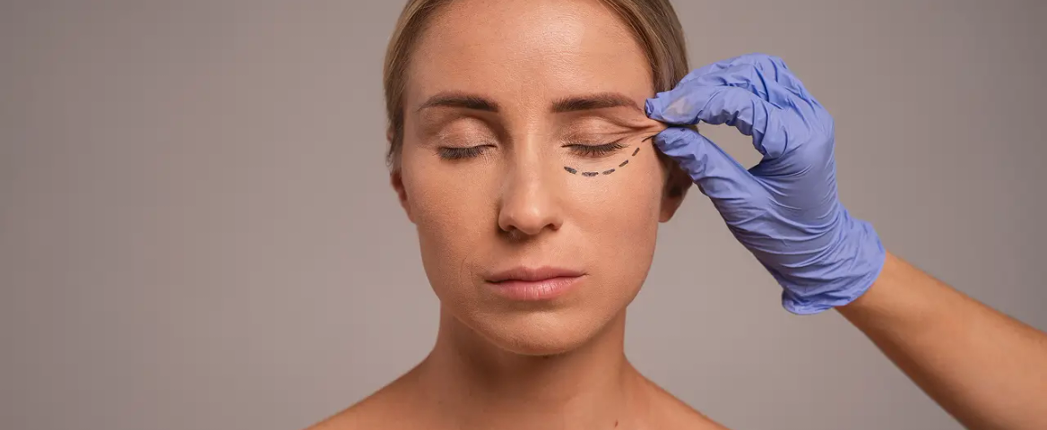 Blepharoplasty