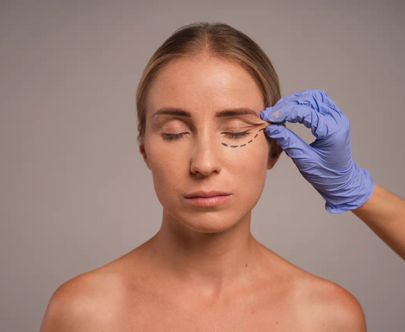 Blepharoplasty